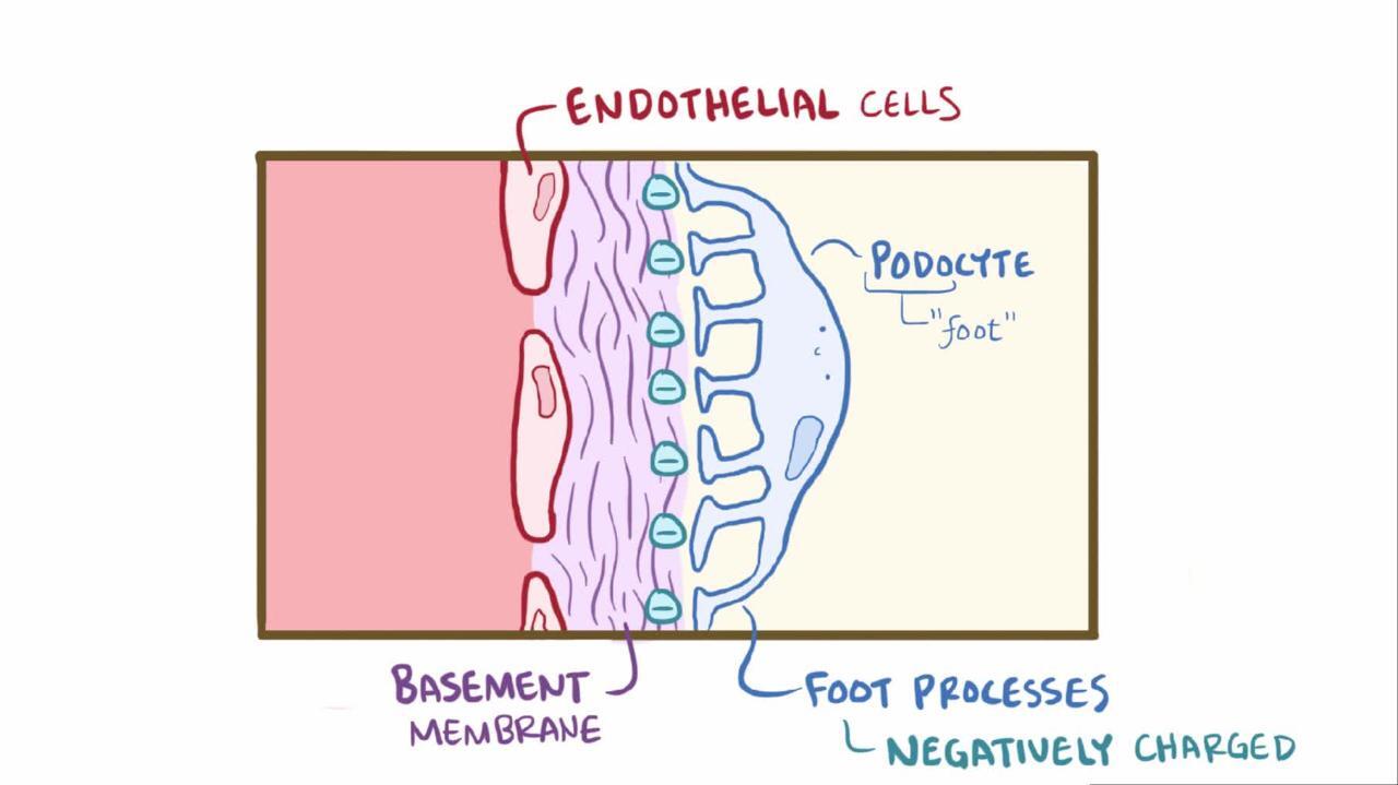 minimal-change-disease