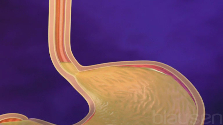 Malattia da reflusso gastroesofageo (GERD) - Disturbi digestivi - Manuale  MSD, versione per i pazienti