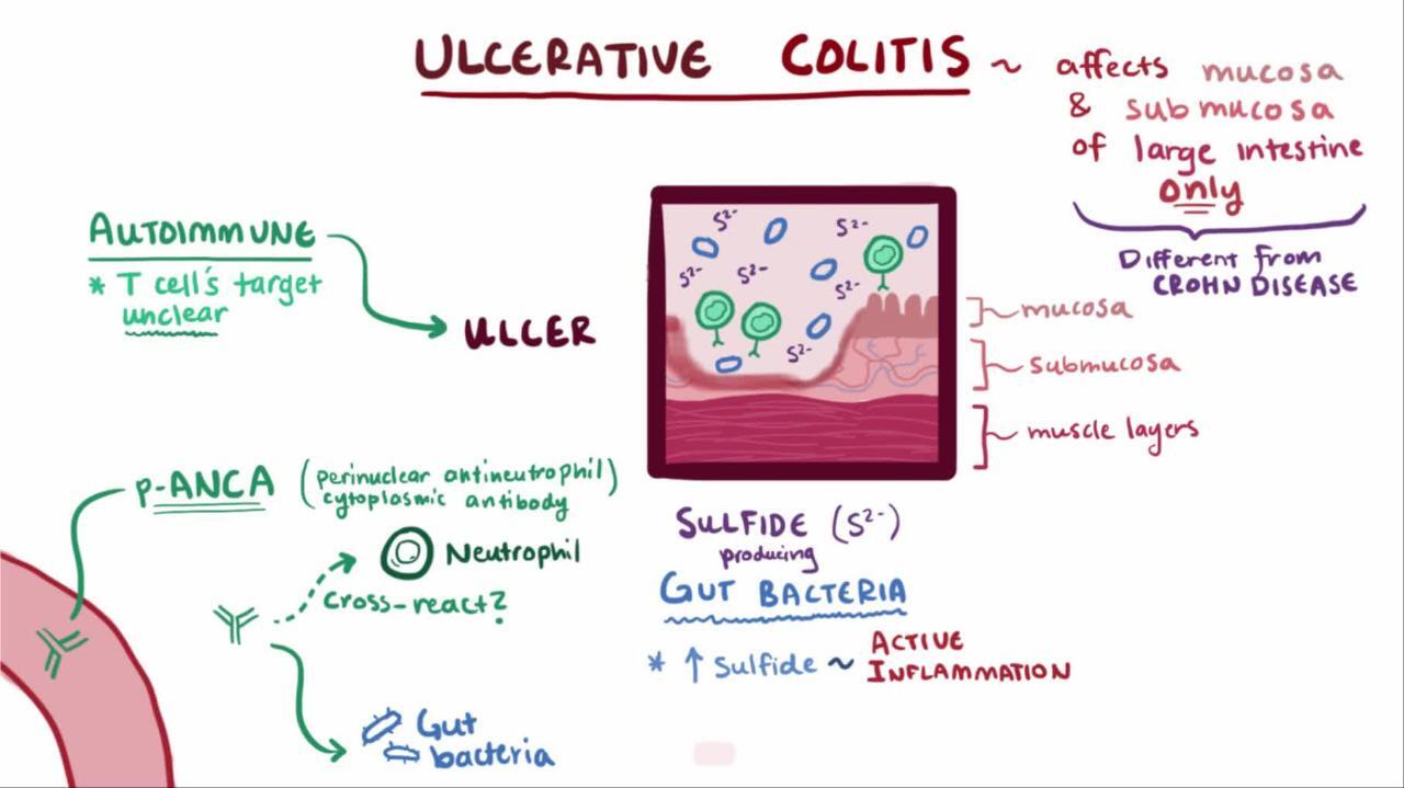 Ulcerative Colitis Gastrointestinal Disorders Merck Manuals Professional Edition 2087