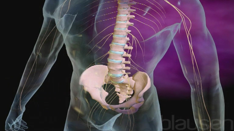Fusione vertebrale lombare