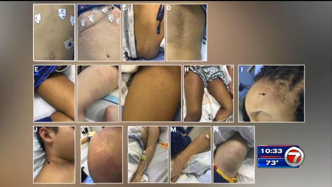 Spotting The Signs Researchers Release Pictures Of Symptom Of Rare Covid Linked Illness In Children Wsvn 7news Miami News Weather Sports Fort Lauderdale