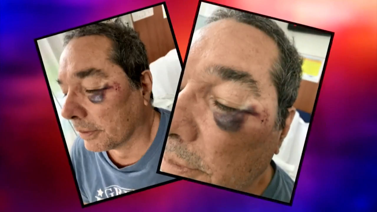 Man hit in face with golf ball months after condo residents raised fears;  Pembroke Pines promises more netting around course