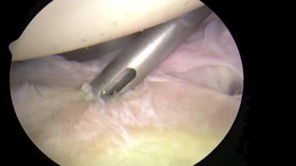 Inferior Suture Anchor Placement During Arthroscopic Bankart