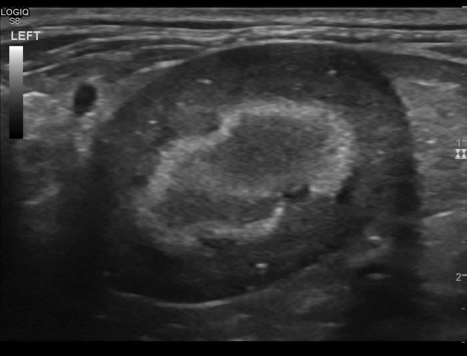 Mn Rim Sign Medullary Rim Sign Cat