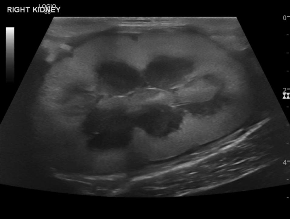 Mn Rim Sign Medullary Rim Sign Cat