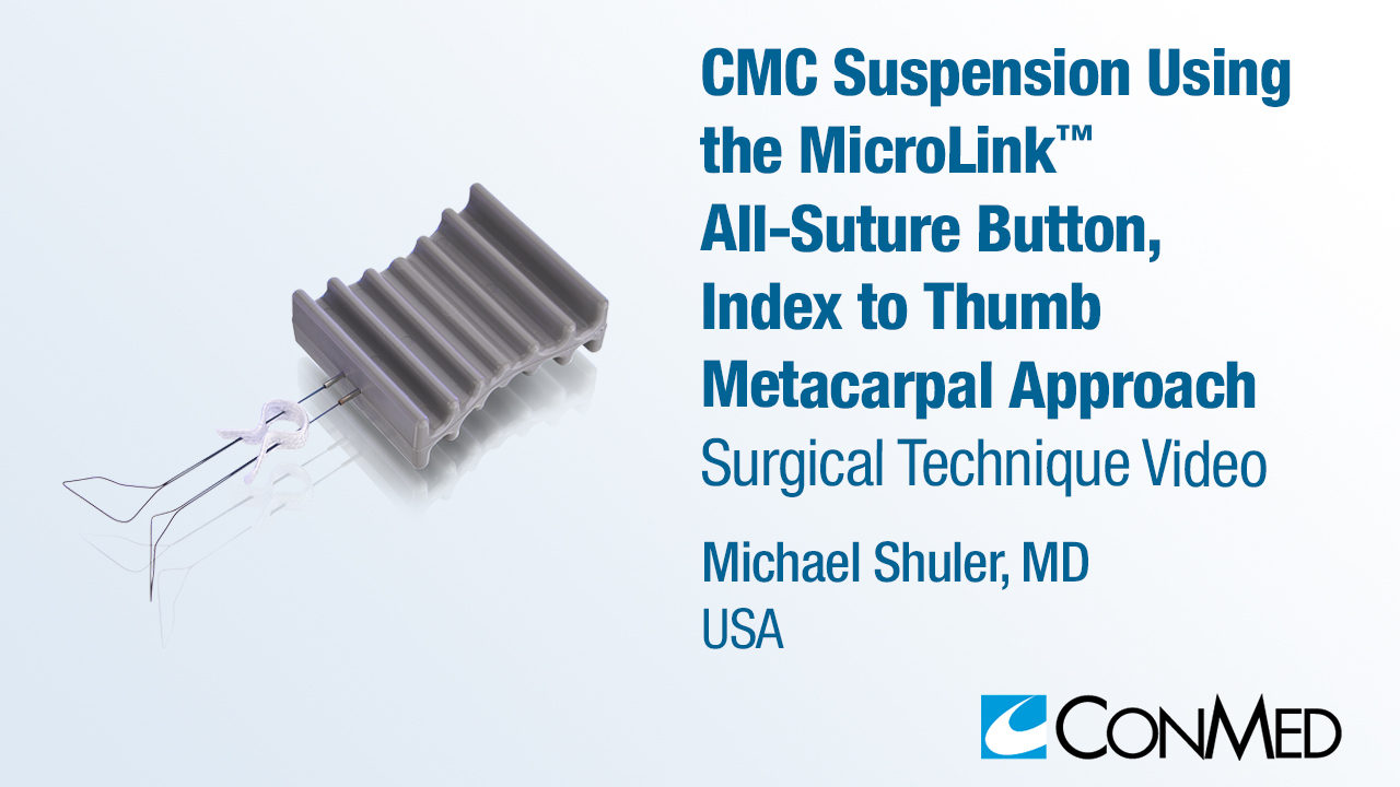 Dr. Shuler - CMC Suspension Using the MicroLink™ All-Suture Button, Index to Thumb Metacarpal Approach