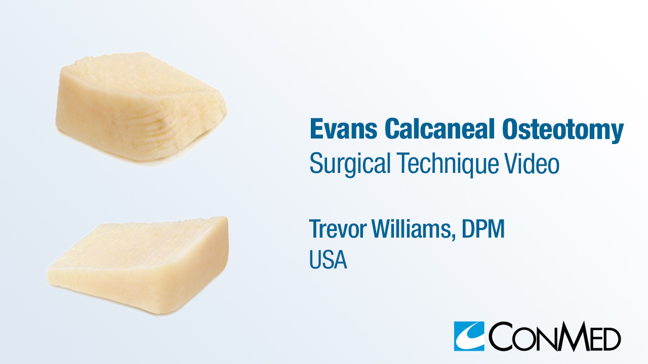 Dr. Williams -  Evans Calcaneal Osteotomy