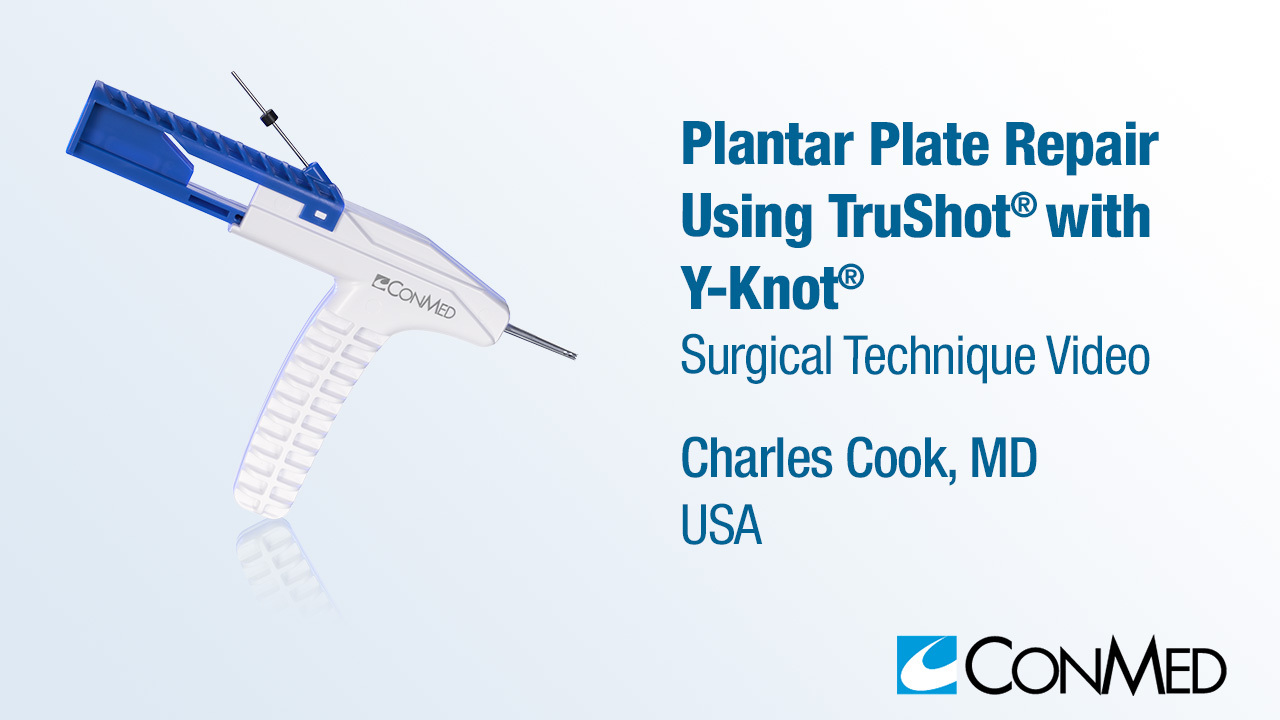 Dr. Cook - Plantar Plate Repair Using TruShot® with Y-Knot®
