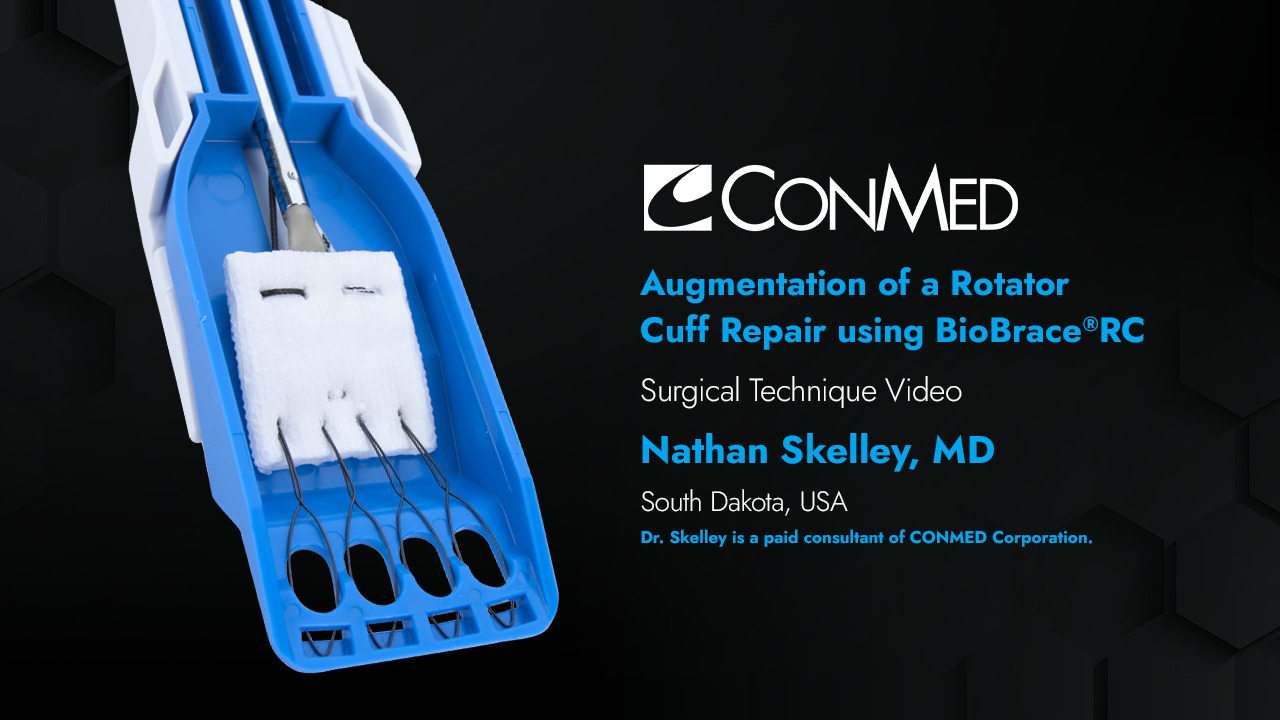 Dr. Nathan Skelley - Augmentation of a Rotator Cuff Repair Using BioBrace®RC