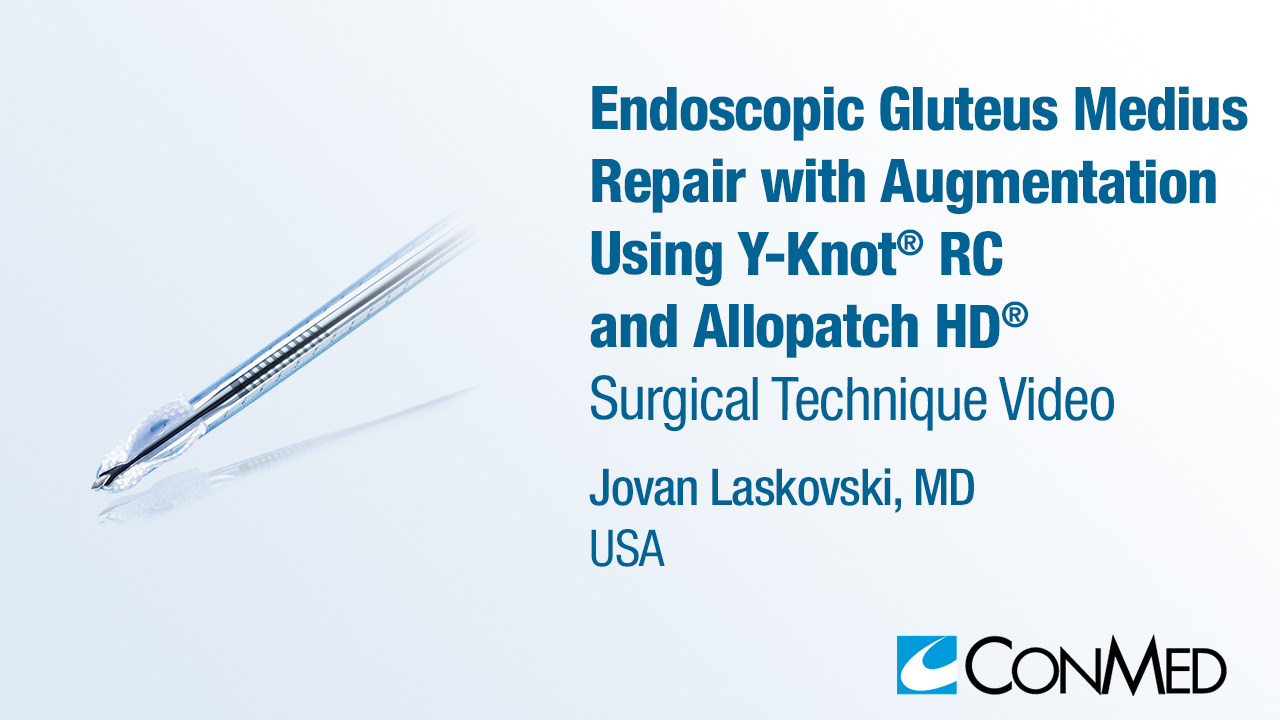 Dr. Laskovski - Endoscopic Gluteus Medius Repair with Augmentation Using Y-Knot® RC and Allopatch HD®