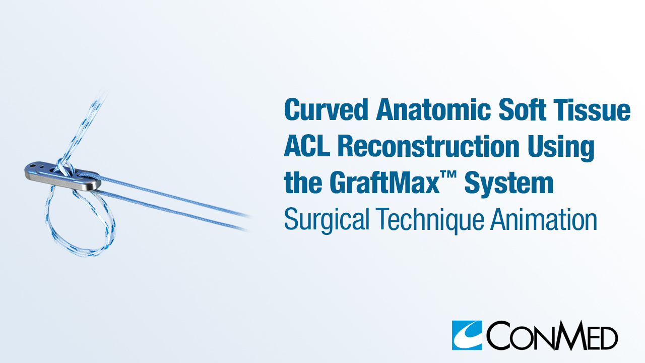 Curved Anatomic Soft Tissue ACL Reconstruction Using the GraftMax™ System
