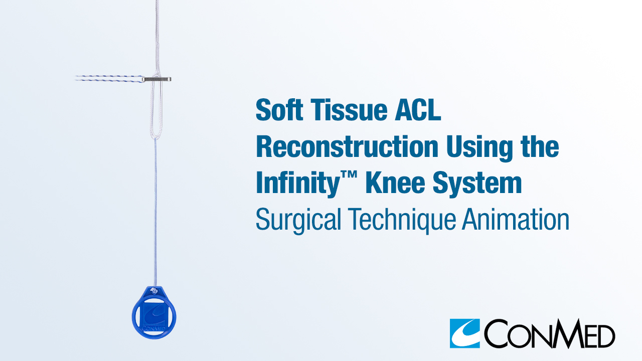 Soft Tissue ACL Reconstruction Using the Infinity™ Knee System