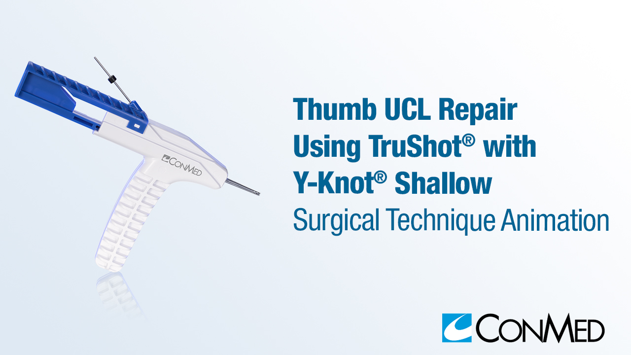 Thumb UCL Repair Using TruShot® with Y-Knot® Shallow