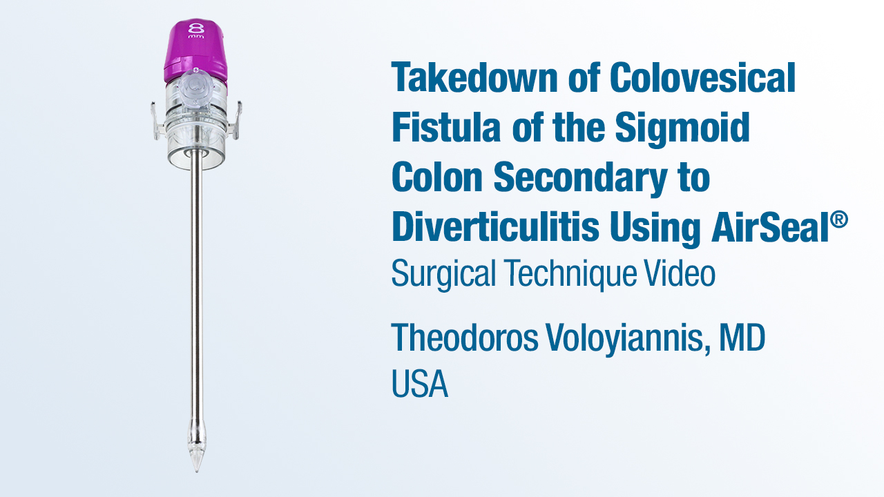 Dr. Voloyiannis - Takedown of Colovesical Fistula of the Sigmoid Colon Secondary to Diverticulitis Using AirSeal® 