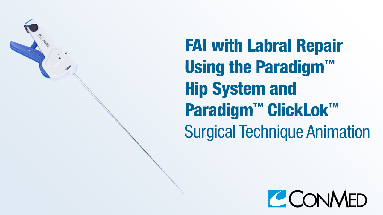 FAI with Labral Repair Using the Paradigm® Hip System and Paradigm® ClickLok™