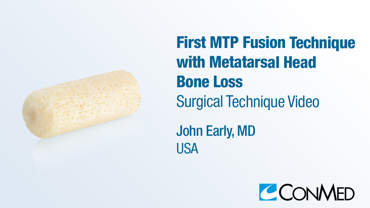 Dr. Early - First MTP Fusion Technique with Metatarsal Head Bone Loss