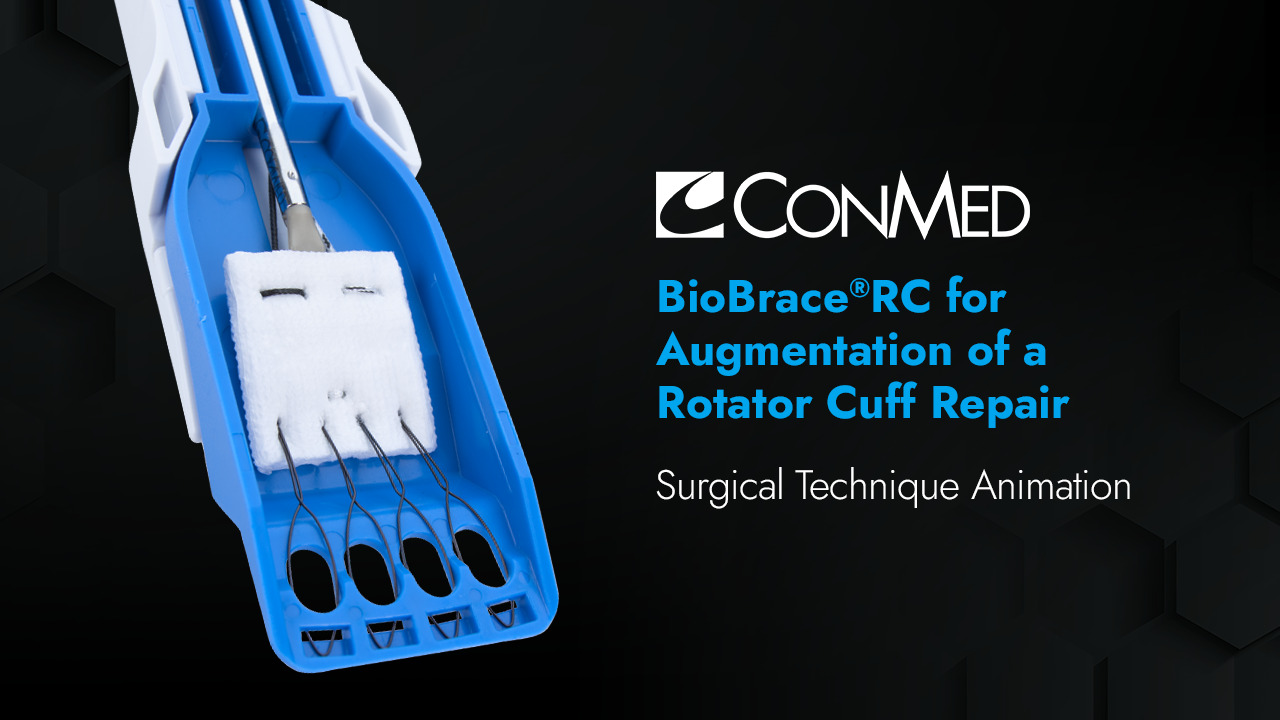 BioBrace®RC for Augmentation of a Rotator Cuff Repair