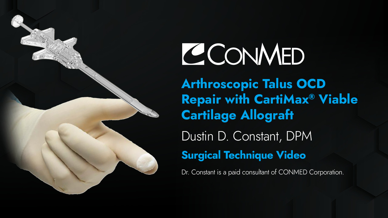 Dr. Constant - Arthroscopic Talus OCD Repair with CartiMax® Viable Cartilage Allograft - Surgical Technique Video