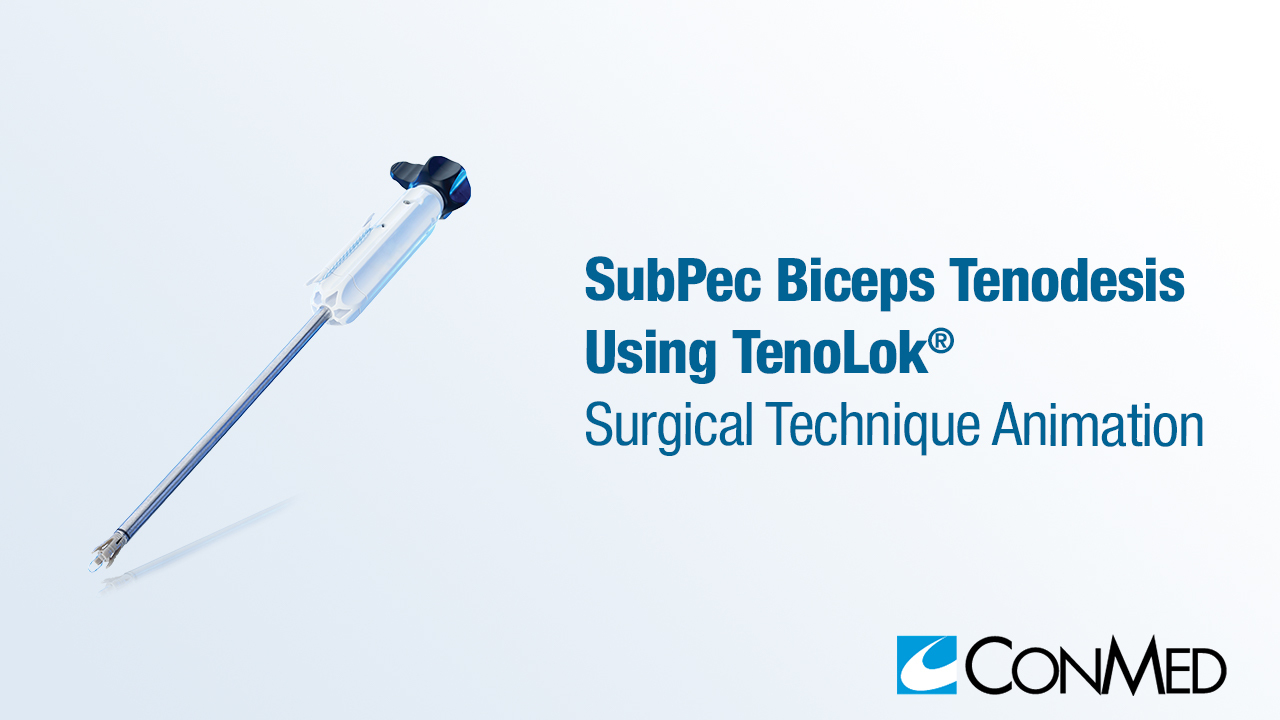 SubPec Biceps Tenodesis Using TenoLok®
