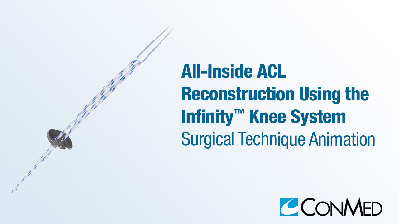 All-Inside ACL Reconstruction Using the Infinity™ Knee System
