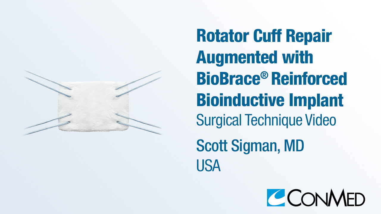 Dr. Sigman - Rotator Cuff Repair Augmented with BioBrace® Reinforced Bioinductive Implant