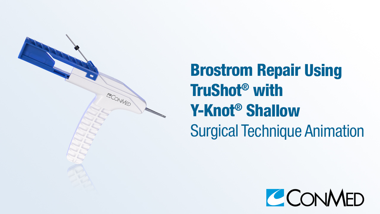 Brostrom Repair Using TruShot® with Y-Knot® Shallow