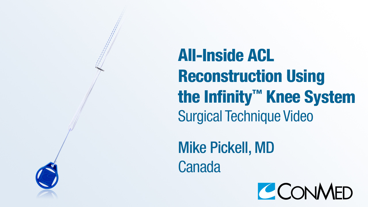 Dr. Pickell - All-Inside ACL Reconstruction Using the Infinity™ Knee System