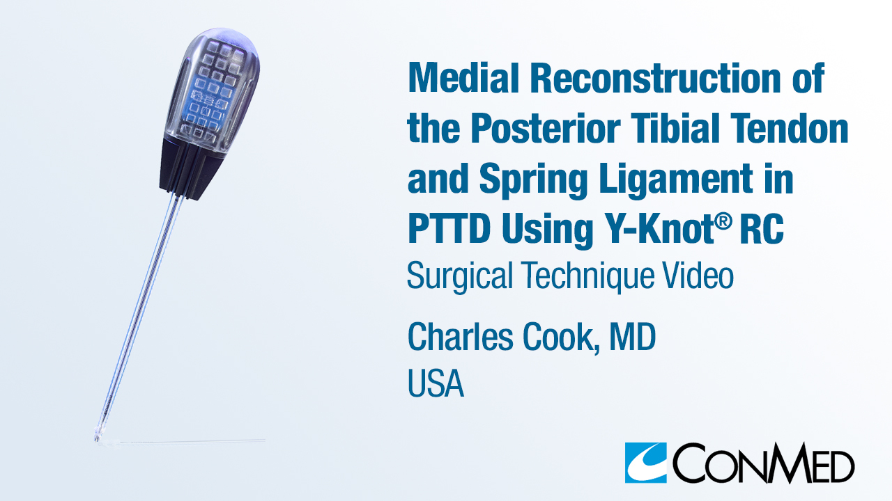 Dr. Cook - FDL Transfer and Spring Ligament Repair Using Y-Knot RC®
