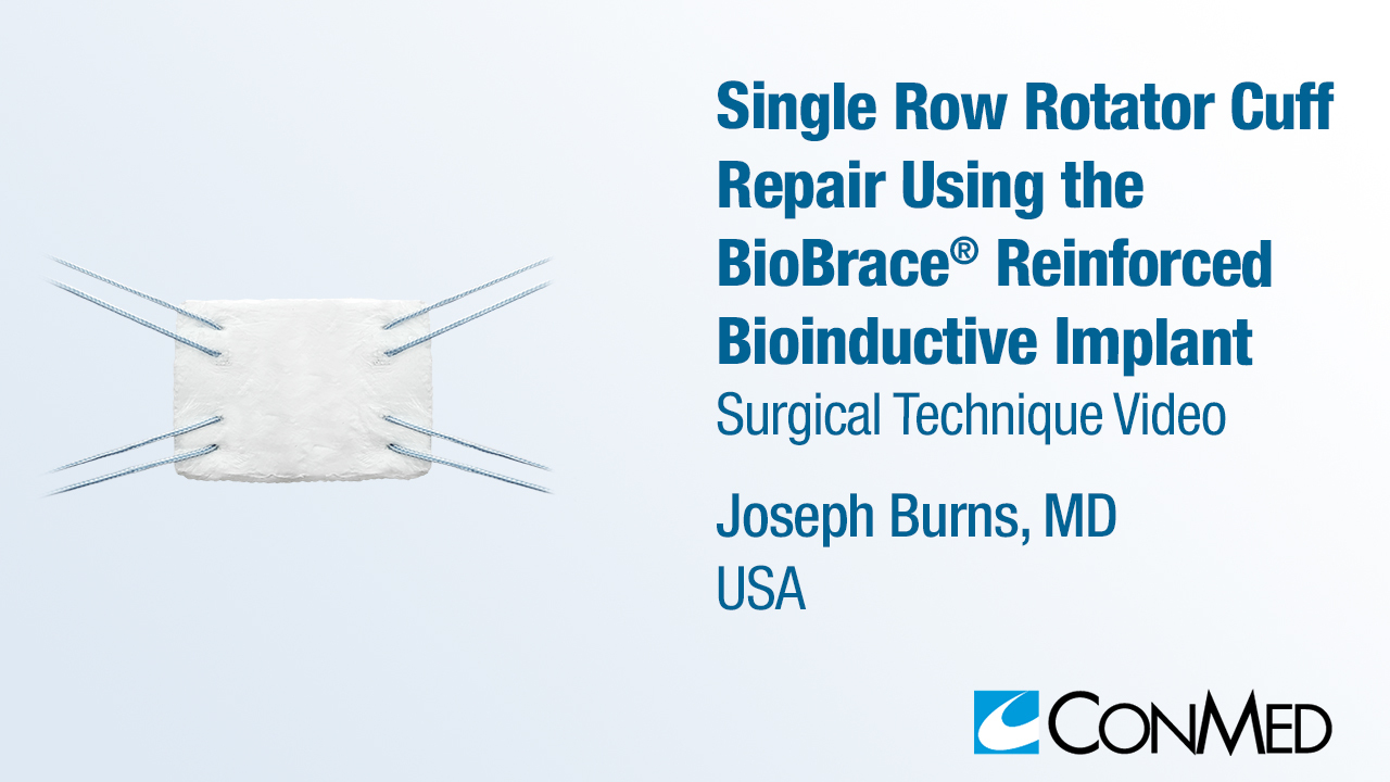 Dr. Burns - Single Row Rotator Cuff Repair Using BioBrace®