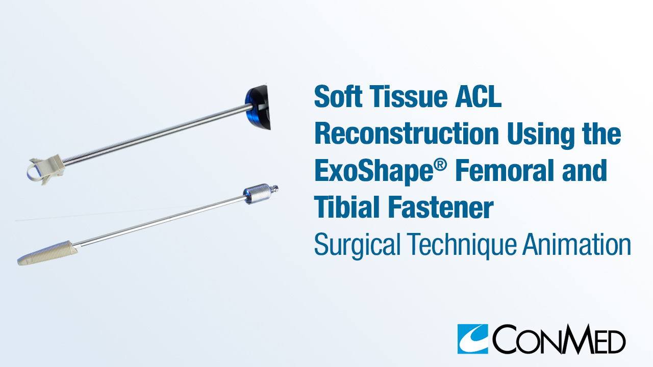 Soft Tissue ACL Reconstruction Using the ExoShape® Femoral and Tibial Fastener