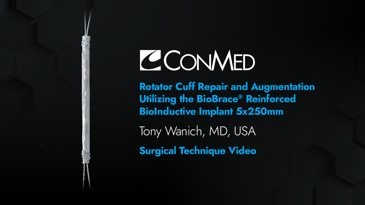 Dr. Wanich - Rotator Cuff Repair and Augmentation Utilizing the BioBrace® Reinforced BioInductive Implant