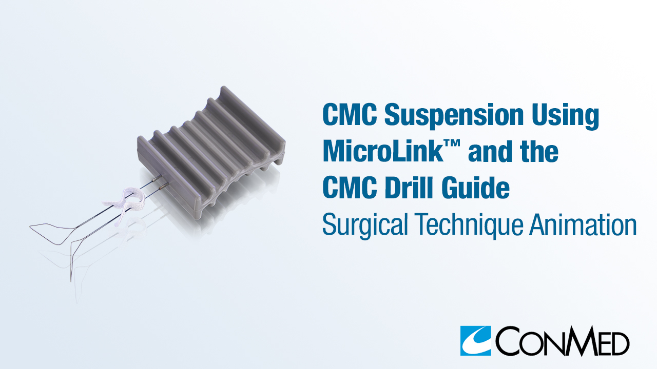 CMC Suspension Using MicroLink™ and the CMC Drill Guide
