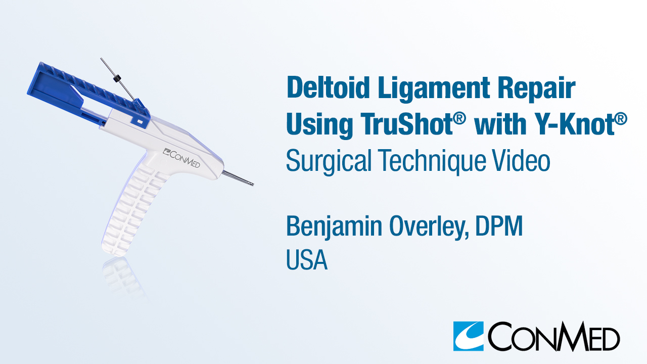Dr. Overley - Deltoid Ligament Repair Using TruShot® with Y-Knot®