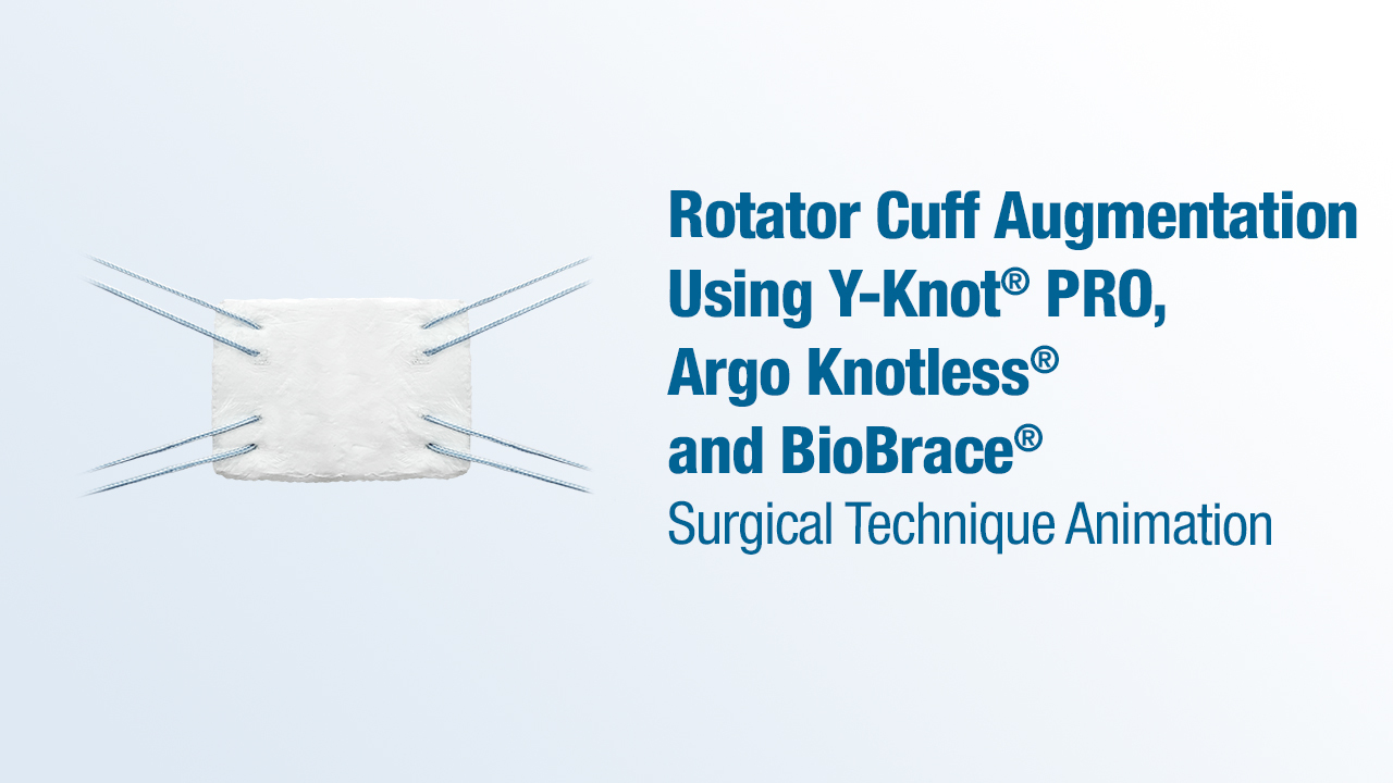 Rotator Cuff Augmentation Using Y-Knot® PRO RC, Argo Knotless®, and BioBrace®