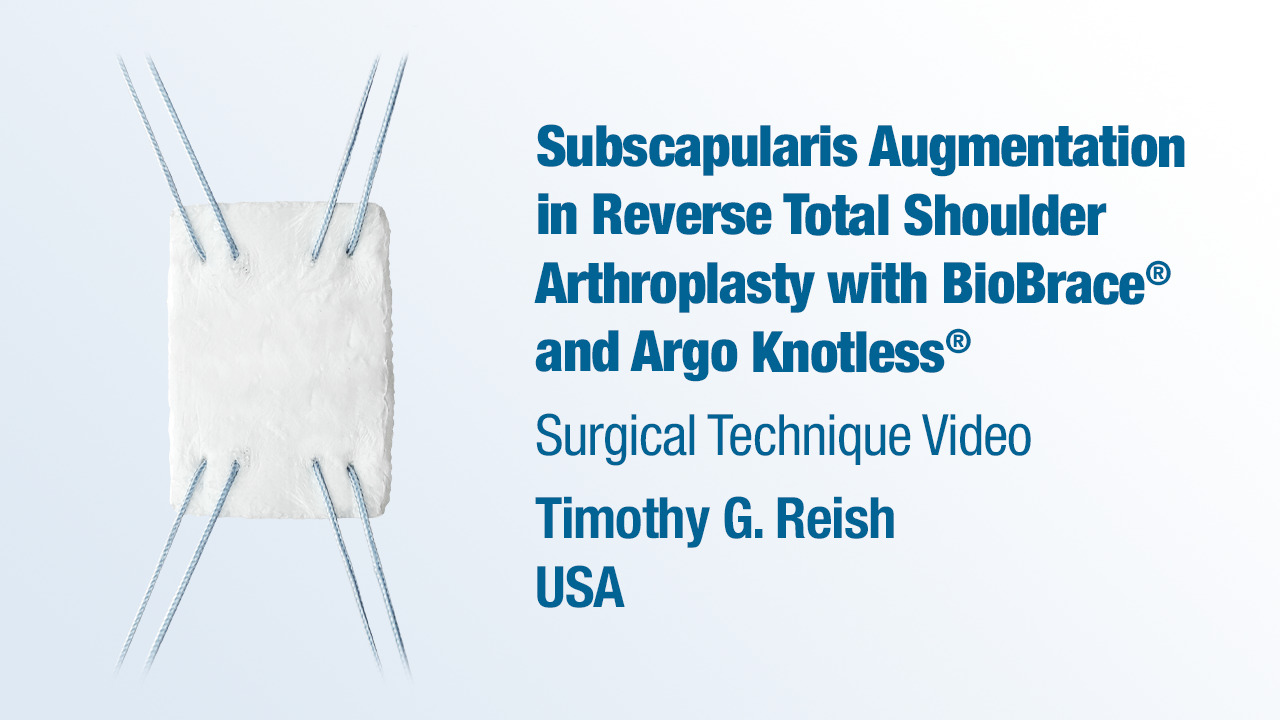 Dr Reish - Subscapularis Augmentation in Reverse TSA with BioBrace® and Argo Knotless®