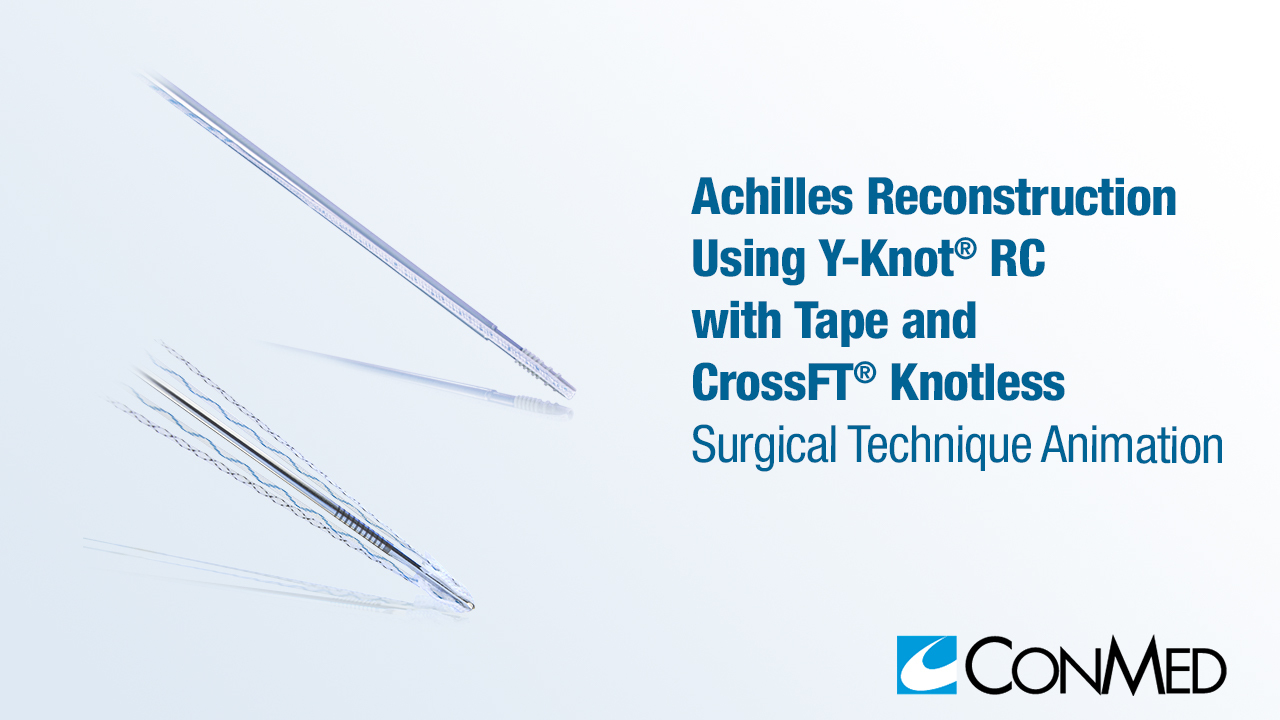Achilles Reconstruction Using Y-Knot® RC with Tape and CrossFT® Knotless
