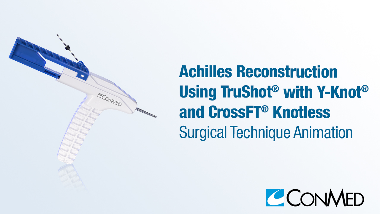 Achilles Reconstruction Using TruShot® with Y-Knot® and CrossFT® Knotless