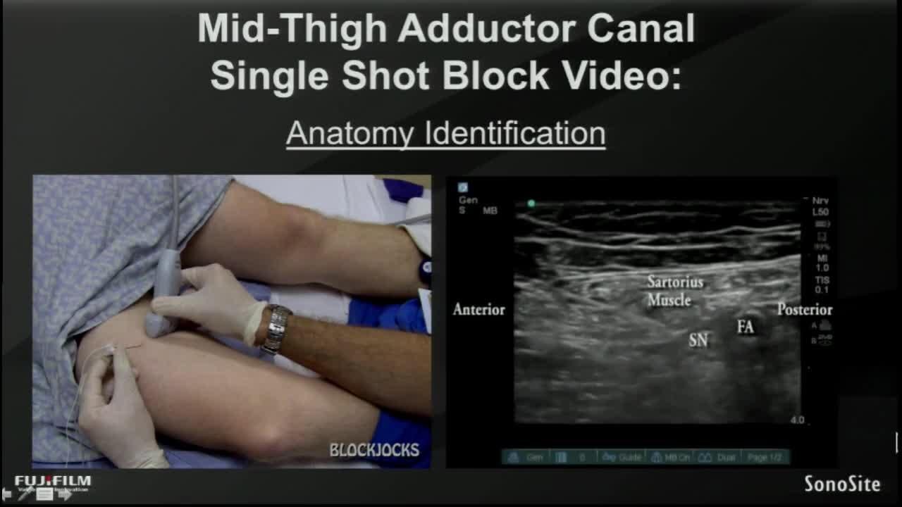 Adductor Canal Block Anatomy
