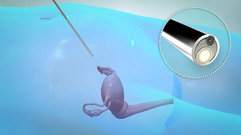 Laparoscopic Hysterectomy Laparoscopic Hysterectomy