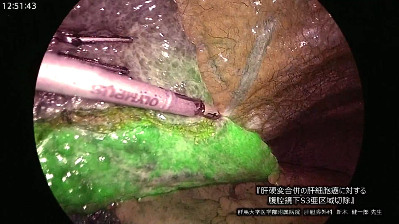 肝硬変　腹腔鏡 