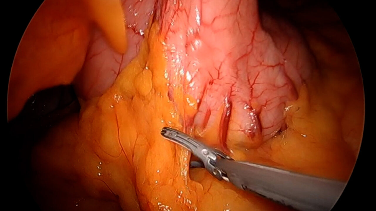 ID Pylorus Begin Dissection