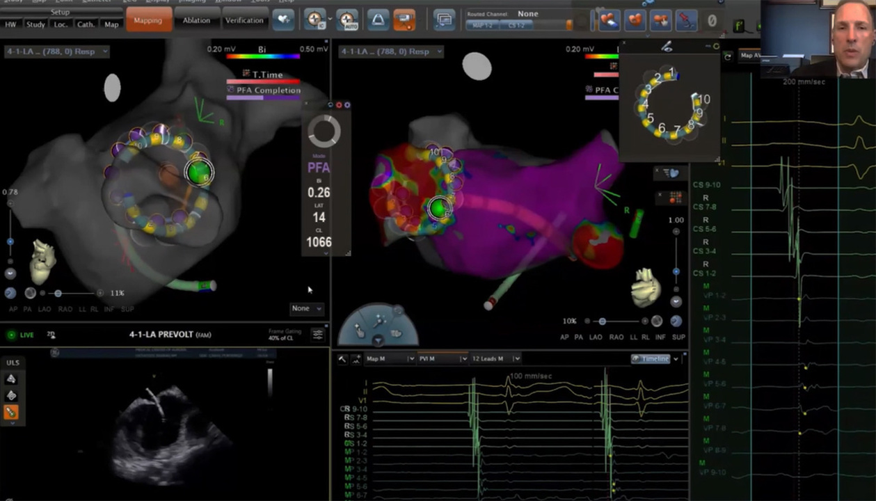 US_ELP_NAVI_400135 - The Power of Integration: Carto™ 3 System and Varipulse™ Catheter