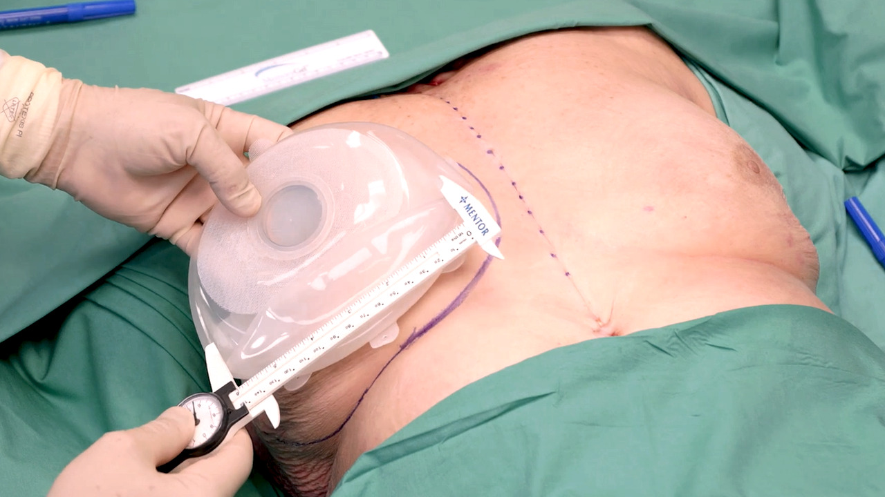 US_MNT_BRST_399828 - Subpectoral breast reconstruction using MENTOR™ MemoryGel™ Enhance Implants with Risal Djohan, MD