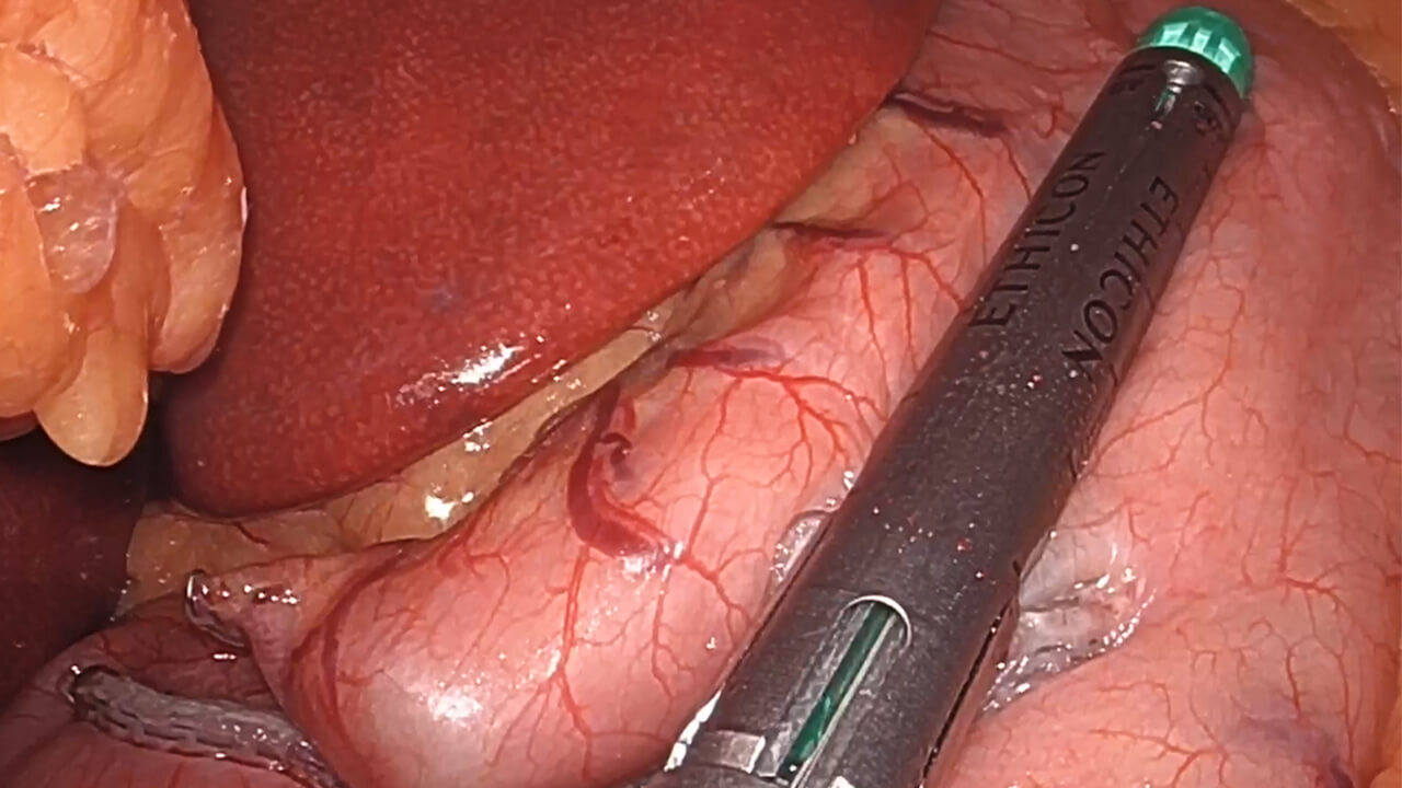 US_ETH_STAP_302493 - One anastomosis gastric bypass using the ECHELON™ 3000 Stapler and VISTASEAL™ Fibrin Sealant with James Dasher, MD