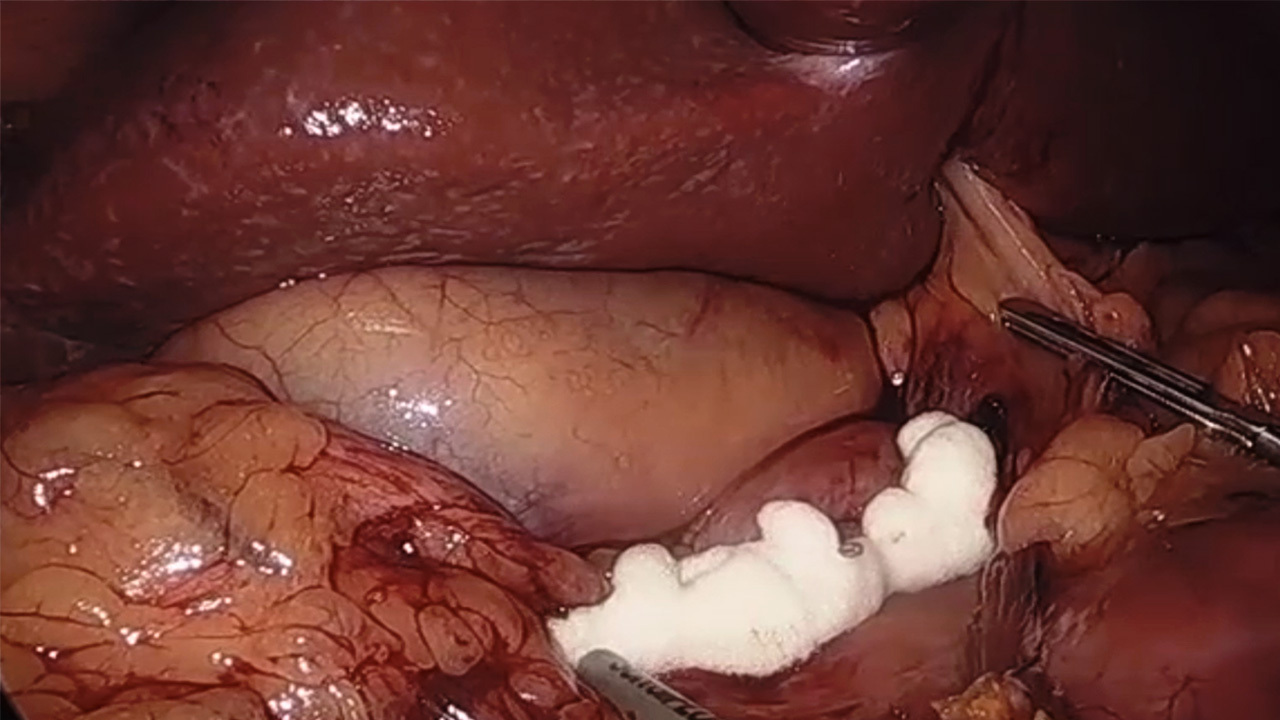 US_ETH_ENER_114690.1 - Single anastomosis duodenal switch using the ECHELON FLEX™ ENDOPATH™ Stapler and SURGIFLO™ Hemostatic Matrix with Mitchell Roslin, MD