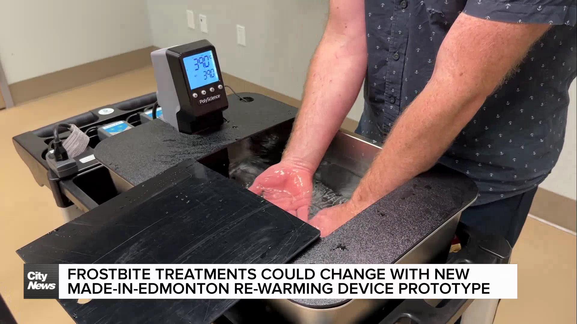 University of Alberta unveils frostbite re-warmer prototype