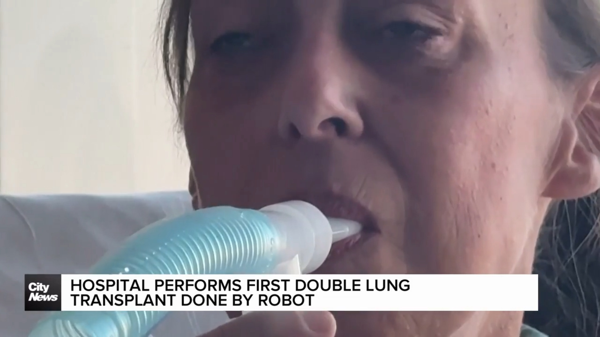 Hospital performs first double lung transplant done by robot