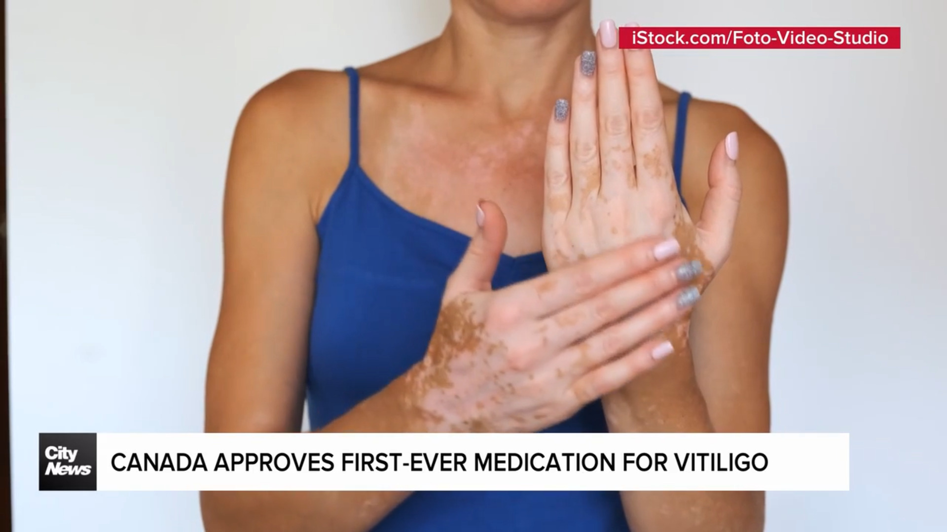 New medication for vitiligo approved in Canada