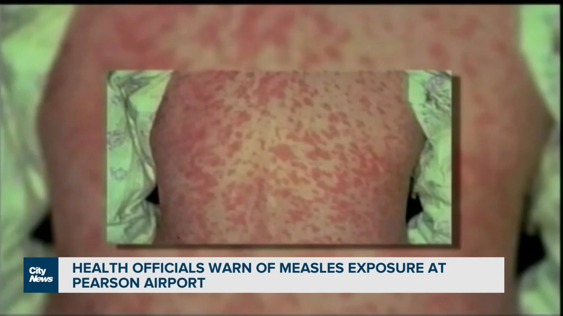 Measles cases on the rise across the globe
