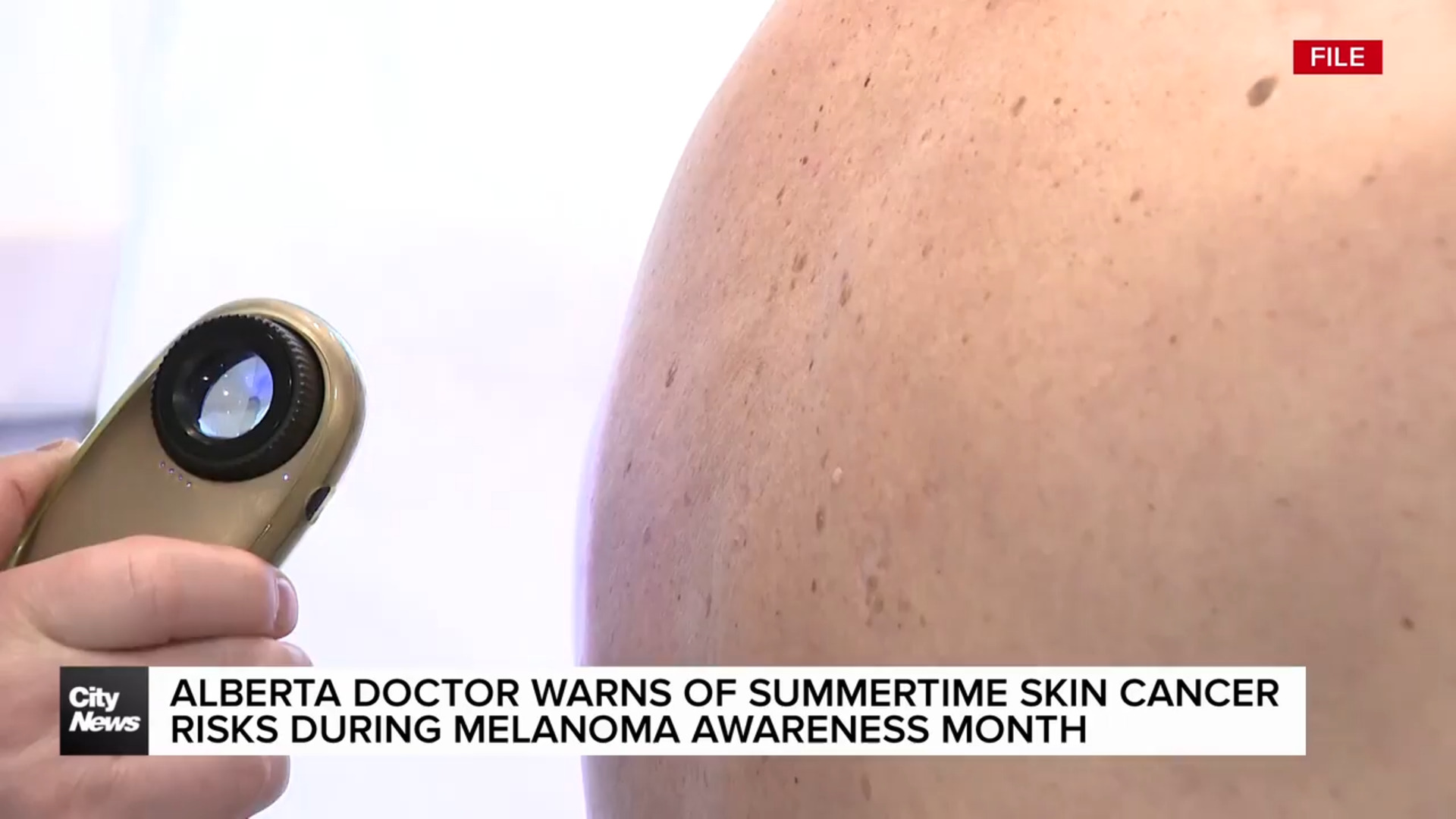Alberta doctor warns of summertime skin cancer risks